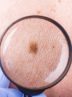 علائم سرطان پوست چیست؟ – ایسنا